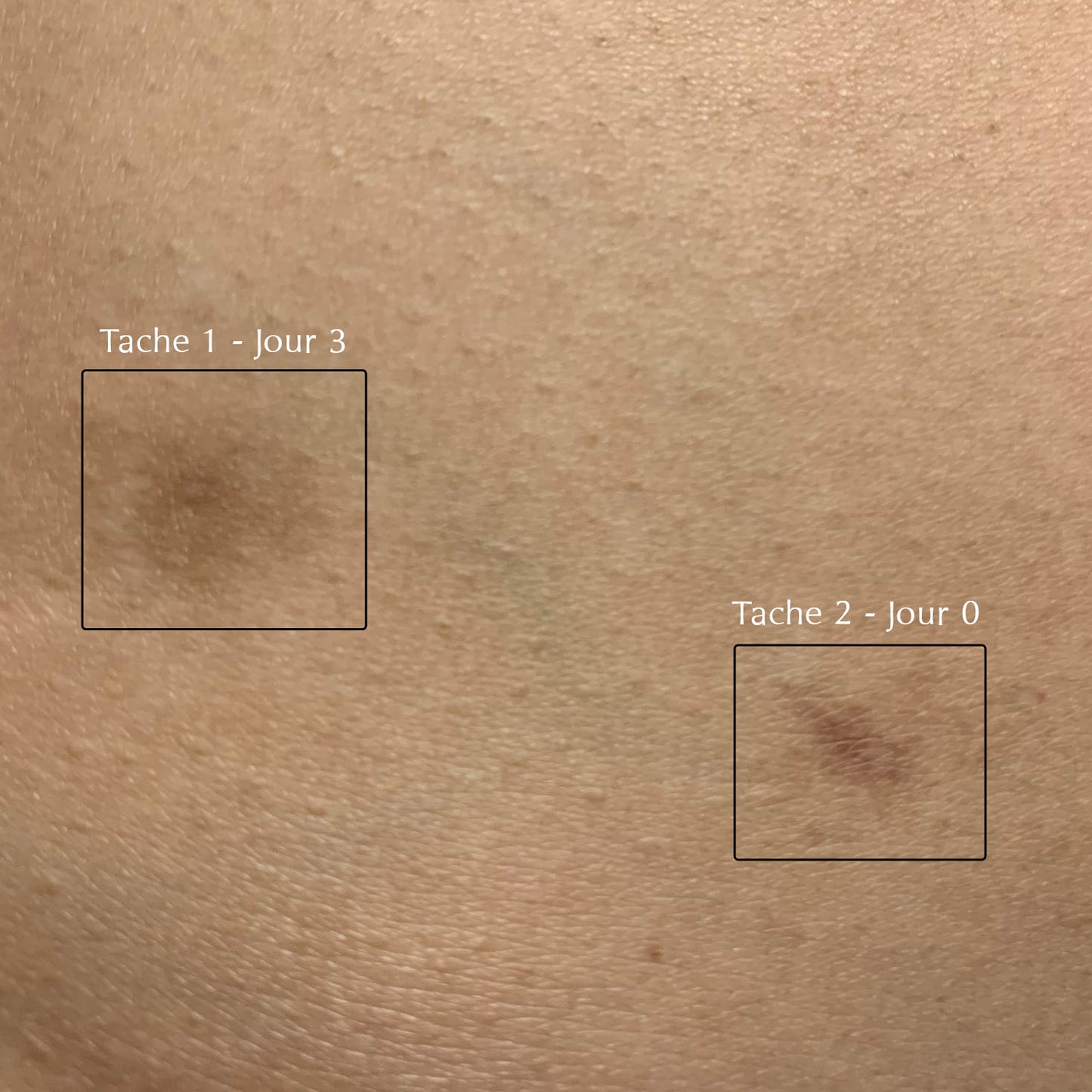 Correcteur Eclaircissant - taches localisées