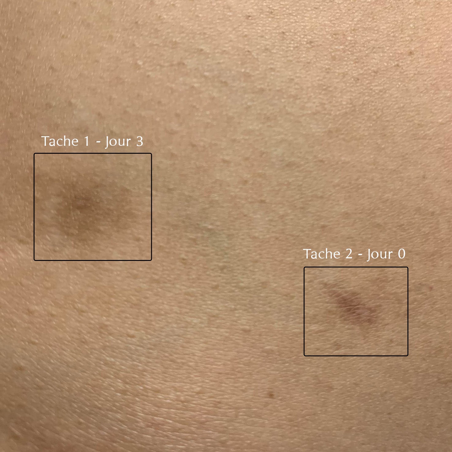 Correcteur Eclaircissant - taches localisées